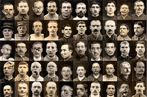 Photograph of the "Blessés de la face." undated photograph. Published in Jalinière, Sciences et Avenir.