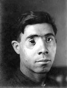 “Headshot. Injured Soldier, M. Giovanni,” U.S. General Hospital No. 2, Fort McHenry, McFee Photograph Collection, PP32.932, MdHS.