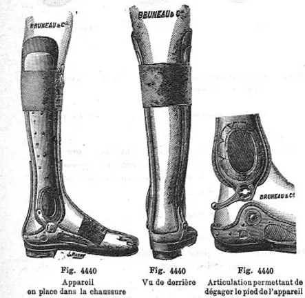 Club-foot instrument, Michel Bruneau model, biusante.parisdescartes.fr