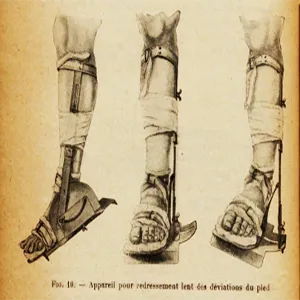 Grace Gassette, Leg brace. Reynier, p. 424.