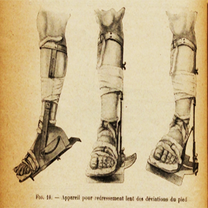 Grace Gassette, leg brace. Reynier 424 Grace Gassette, Leg brace. Reynier, p. 424.